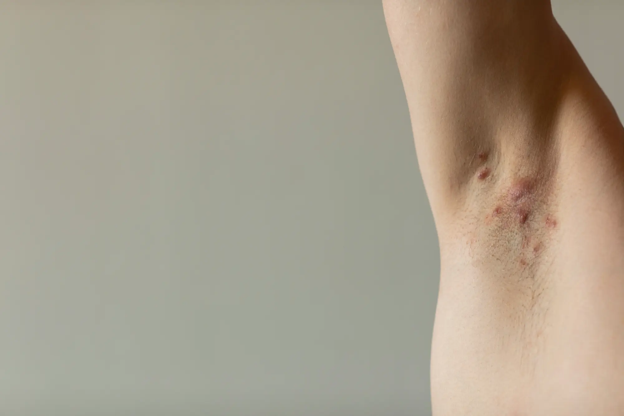 example of Hidradenitis Suppurativa under the arm